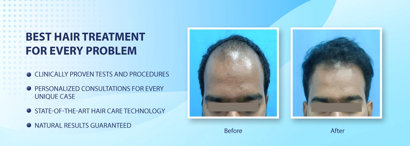 Hair Transplant Facts Procedure and Everything You Need to Know  Care  Well Medical Centre