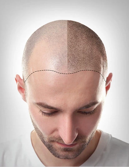 Scalp Micro Pigmentation