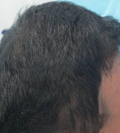 Hair rejuvation therapy after photo in VCare