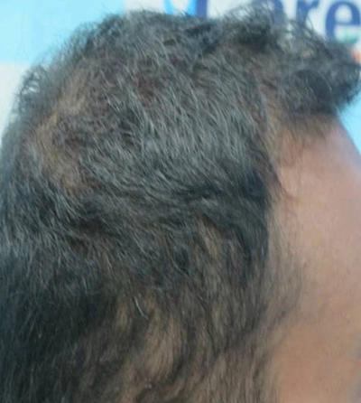 Hair rejuvation therapy before photo in VCare