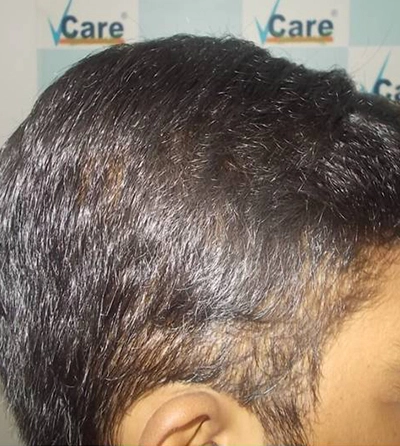 Hair rejuvation therapy after photo in VCare
