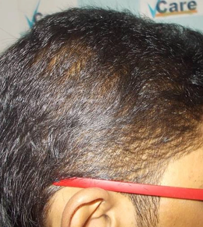 Hair rejuvation therapy before photo in VCare