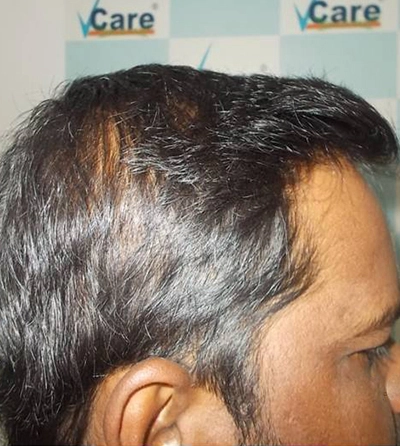 Hair rejuvation therapy after photo in VCare