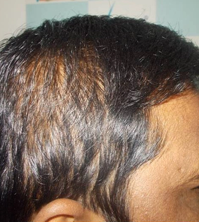Hair rejuvation therapy before photo in VCare