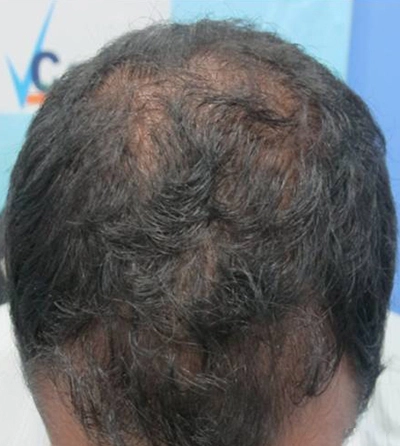 Before After - Hair Loss Treatments - VCare Trichology
