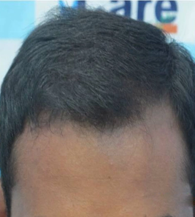 Hair rejuvation therapy after photo in VCare