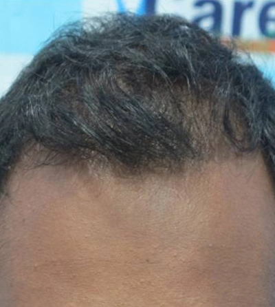 Hair rejuvation therapy before photo in VCare
