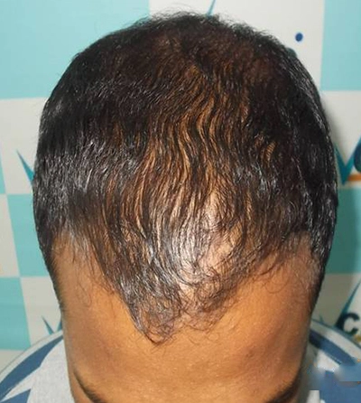 Hair rejuvation therapy after photo in VCare