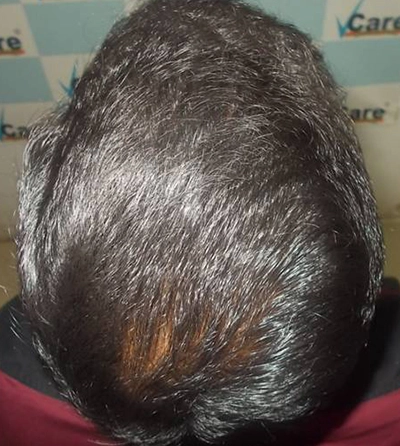 Hair rejuvation therapy after photo in VCare