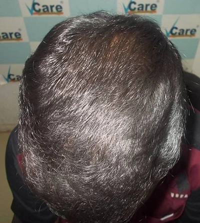 Hair rejuvation therapy after photo in VCare