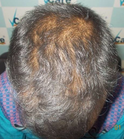 Hair rejuvation therapy before photo in VCare
