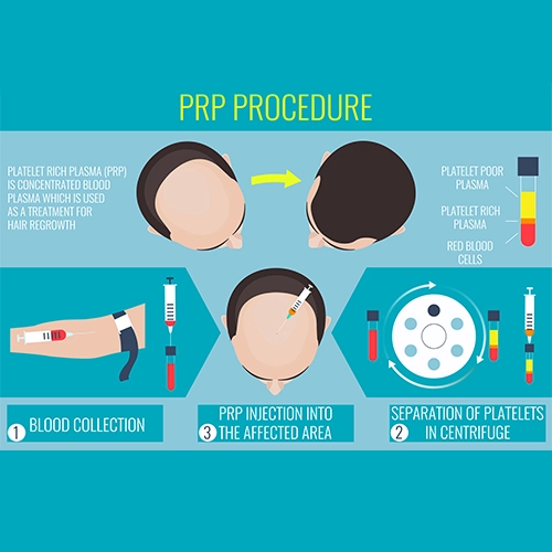 platelet-rich-plasma