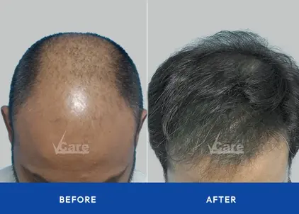Before and after