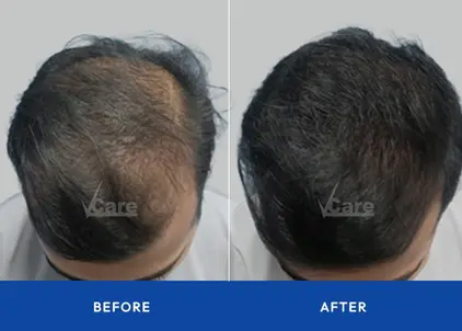 Before and after