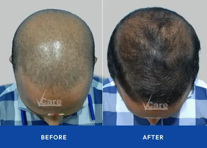 Before and after
