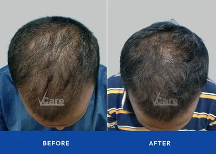 Before and after