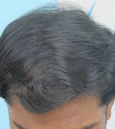 scalp_micro_pigmentation_before