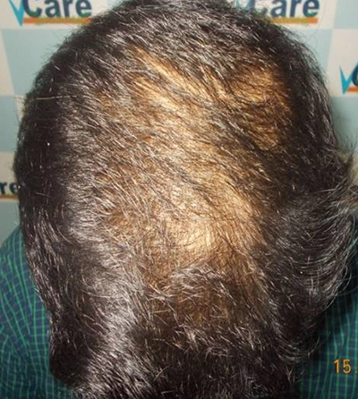 scalp_micro_treatment_before_image_vcare