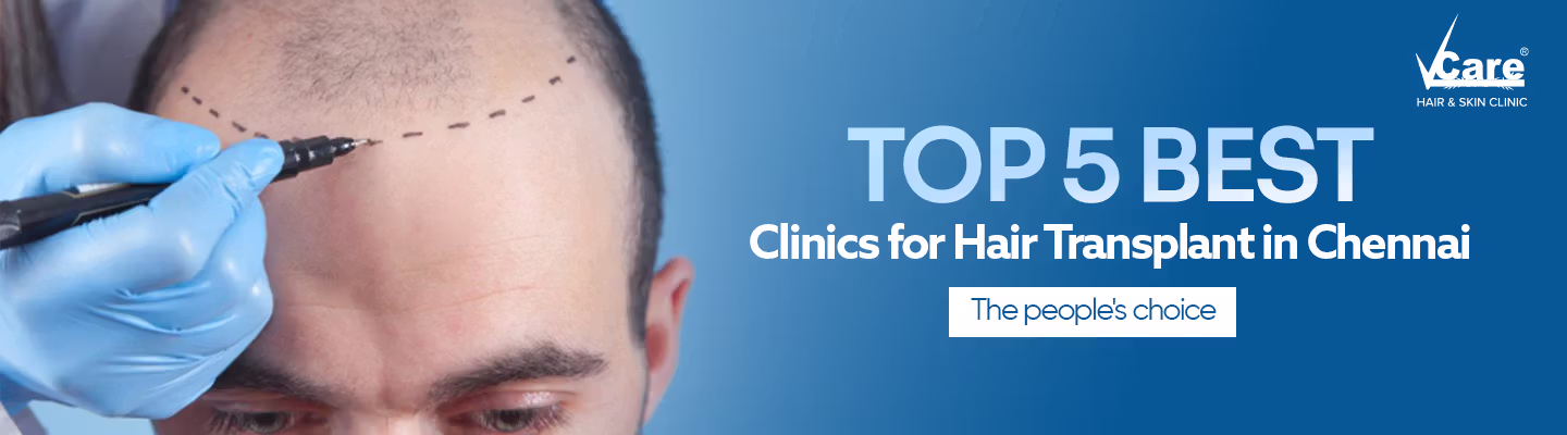 Top 5 Best Hair Transplant Clinics in Chennai