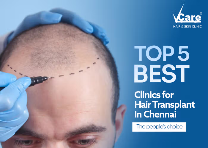 Top 5 Best Hair Transplant Clinics in Chennai