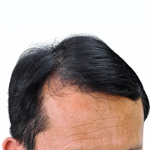 androgenetic_alopecia_vcare