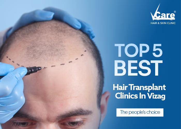 Top 5 Best Hair Transplant Clinics in visakhapatnam