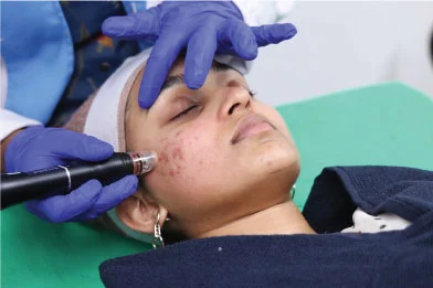 acne treatment
