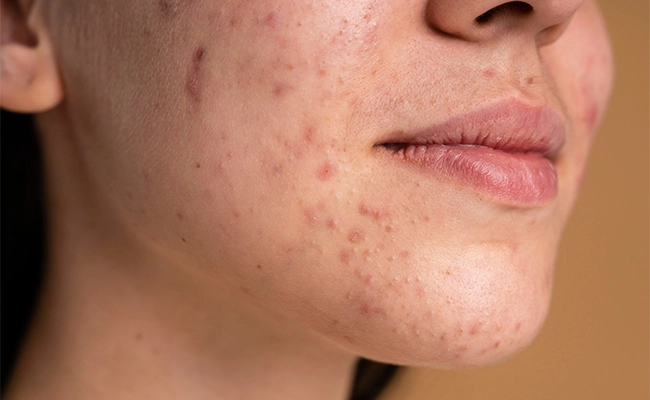 acne