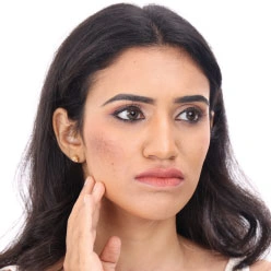 acne treatment