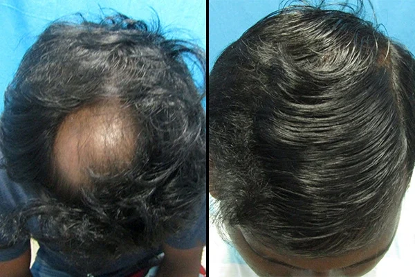 hair regrowth treatment
