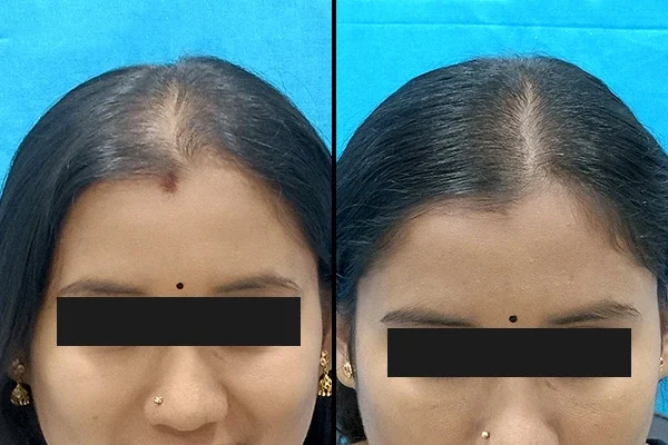 hair regrowth treatment