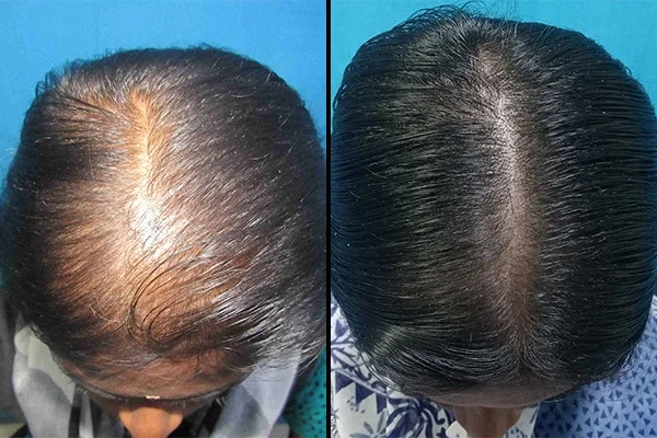 hair regrowth treatment