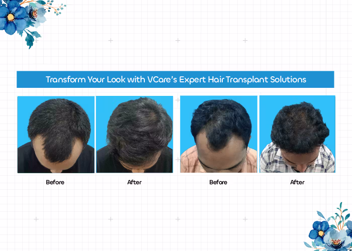 vcare transplantation treatment