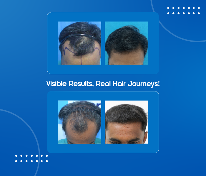 vcare transplantation treatment