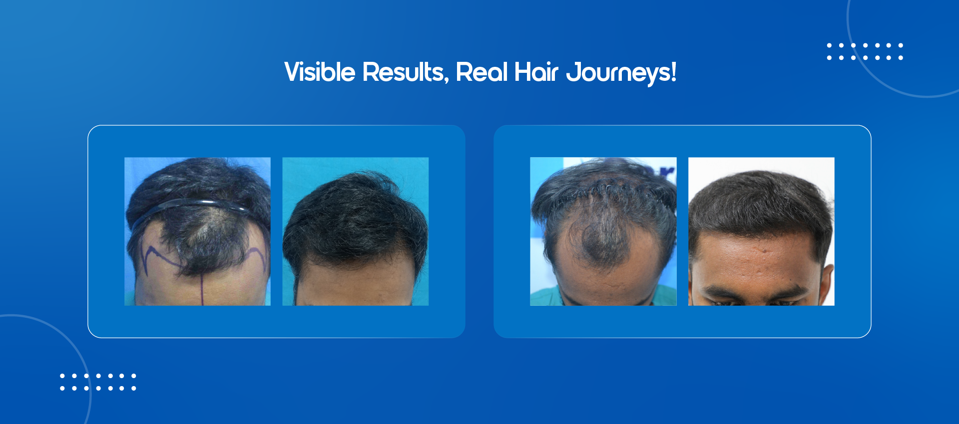 vcare transplantation treatment