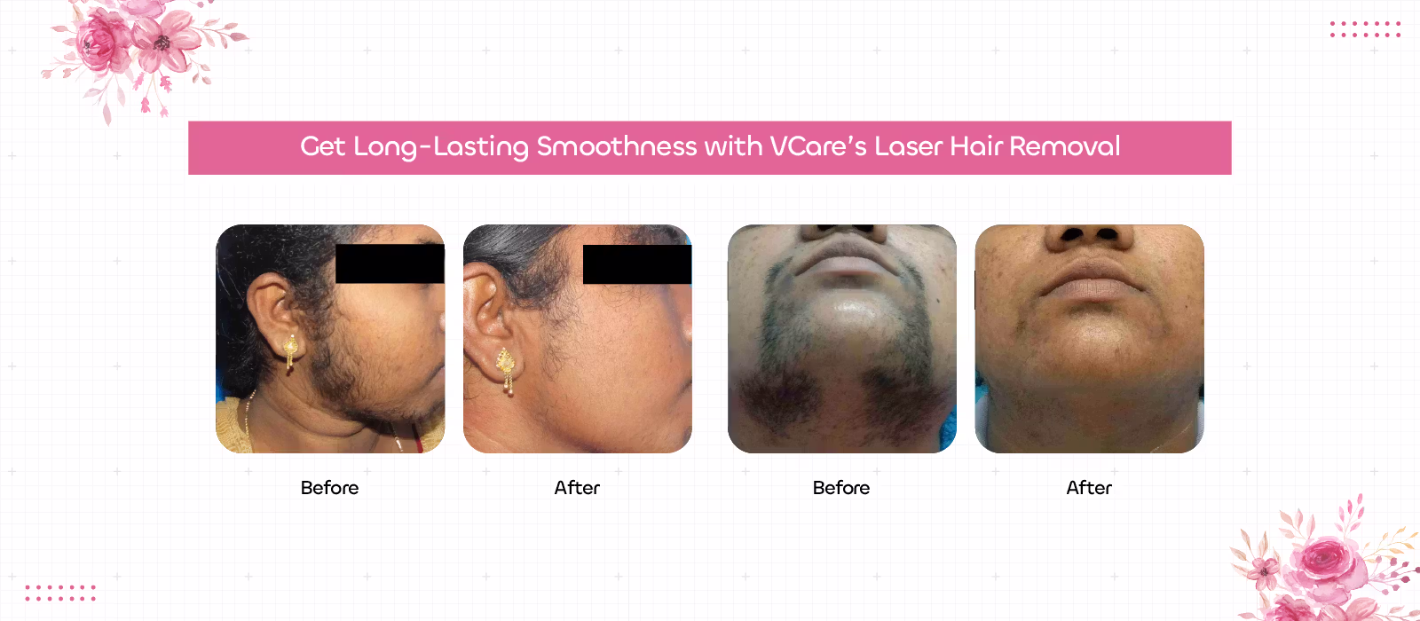 laser hair treatment
                        