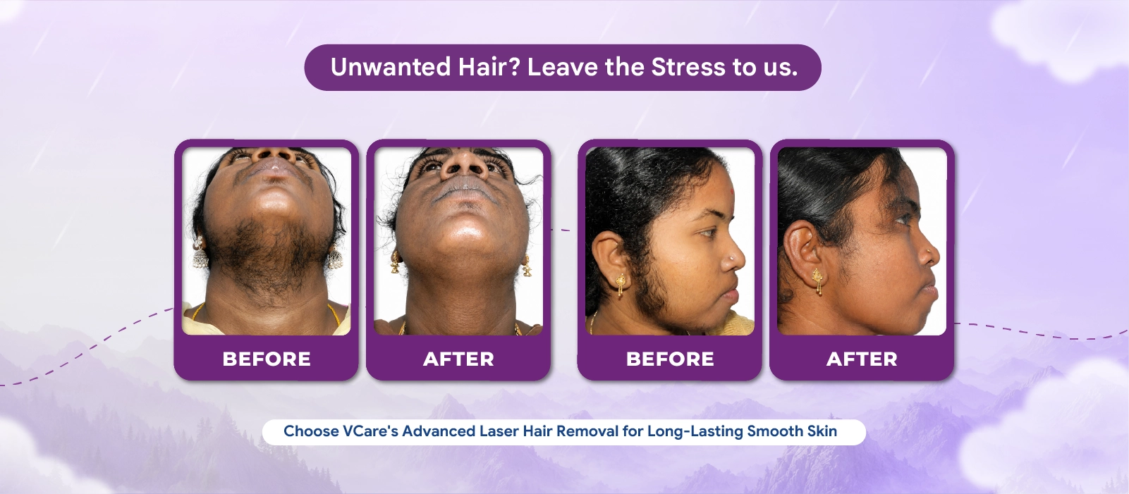 laser hair treatment
                    