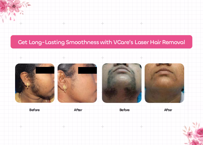 laser hair treatment
                        