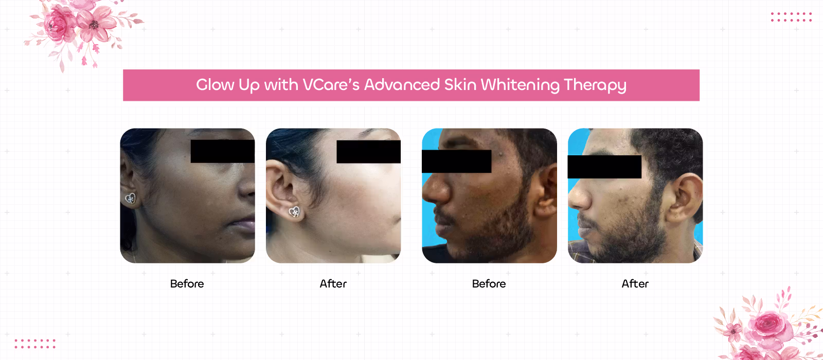 skin whitening treatment