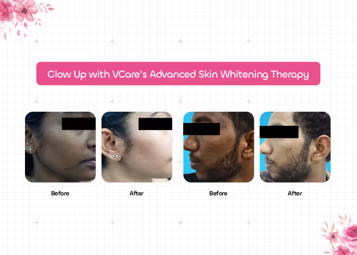 skin whitening treatment