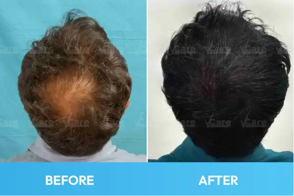 Hair Loss Before