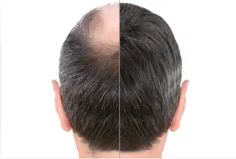 Hair-Regrowth
