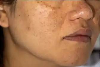 Pigmentation