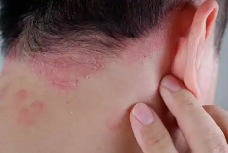 Psoriasis-Treatment