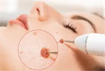Wart-Removal