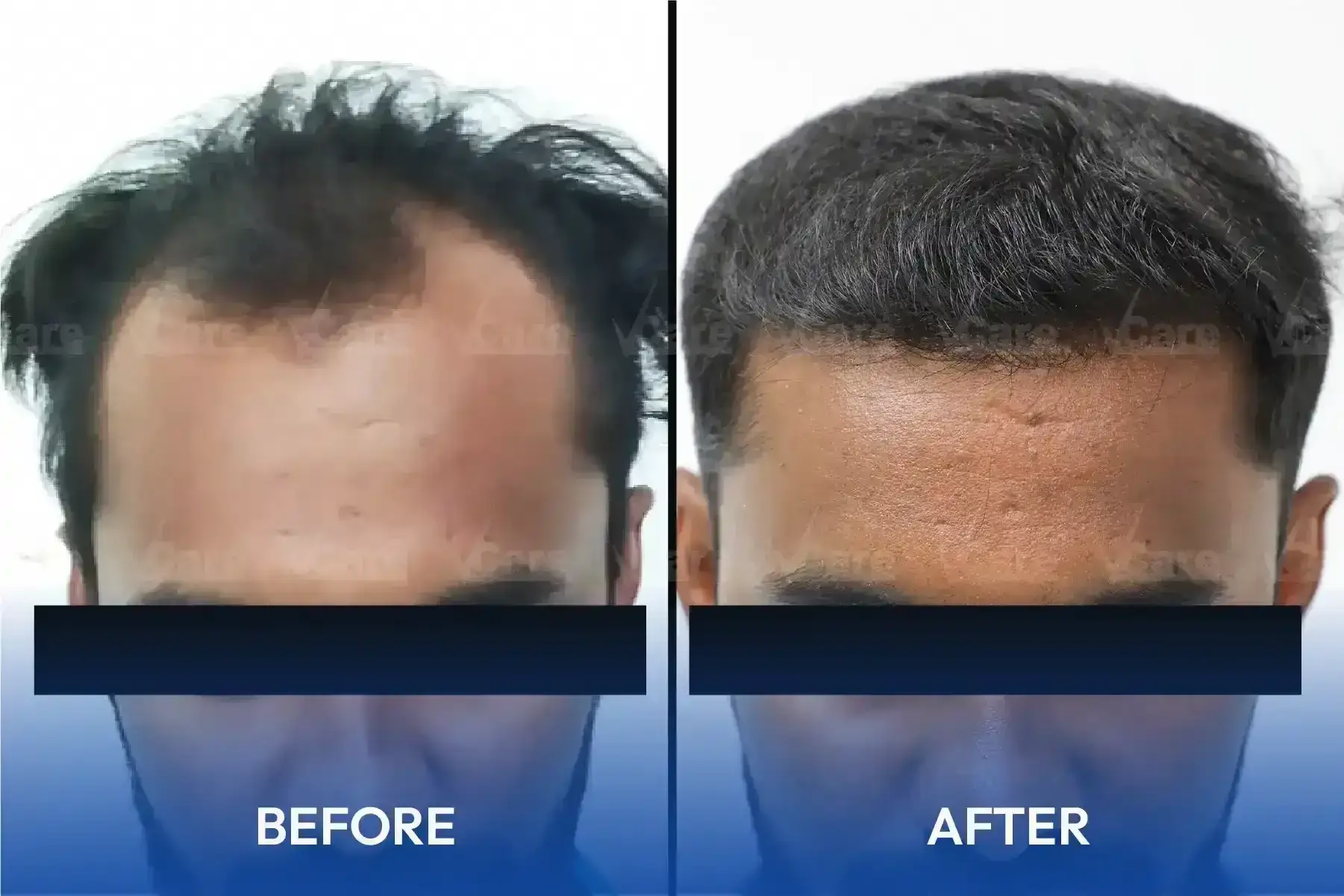 Best hair transplant clinic