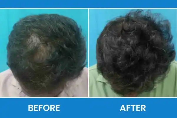Hair Loss Before