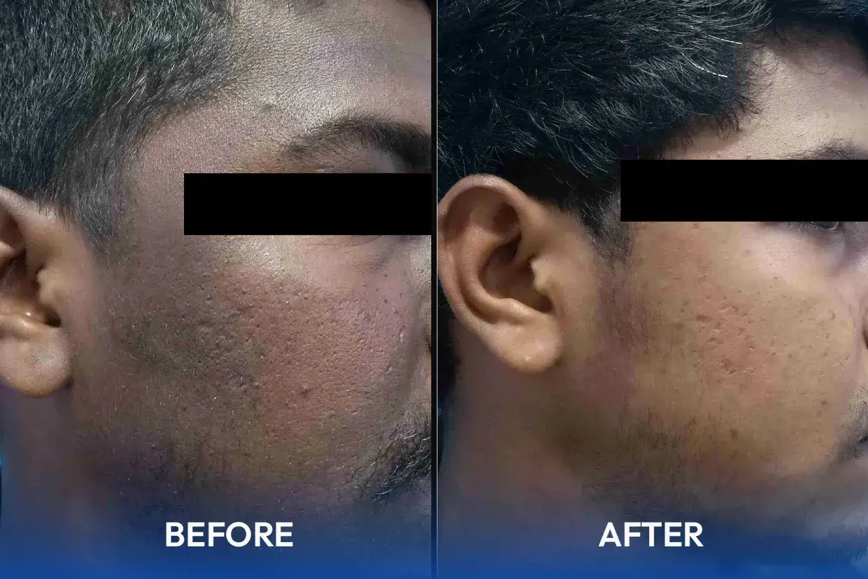 Laser Hair Removal Treatment
