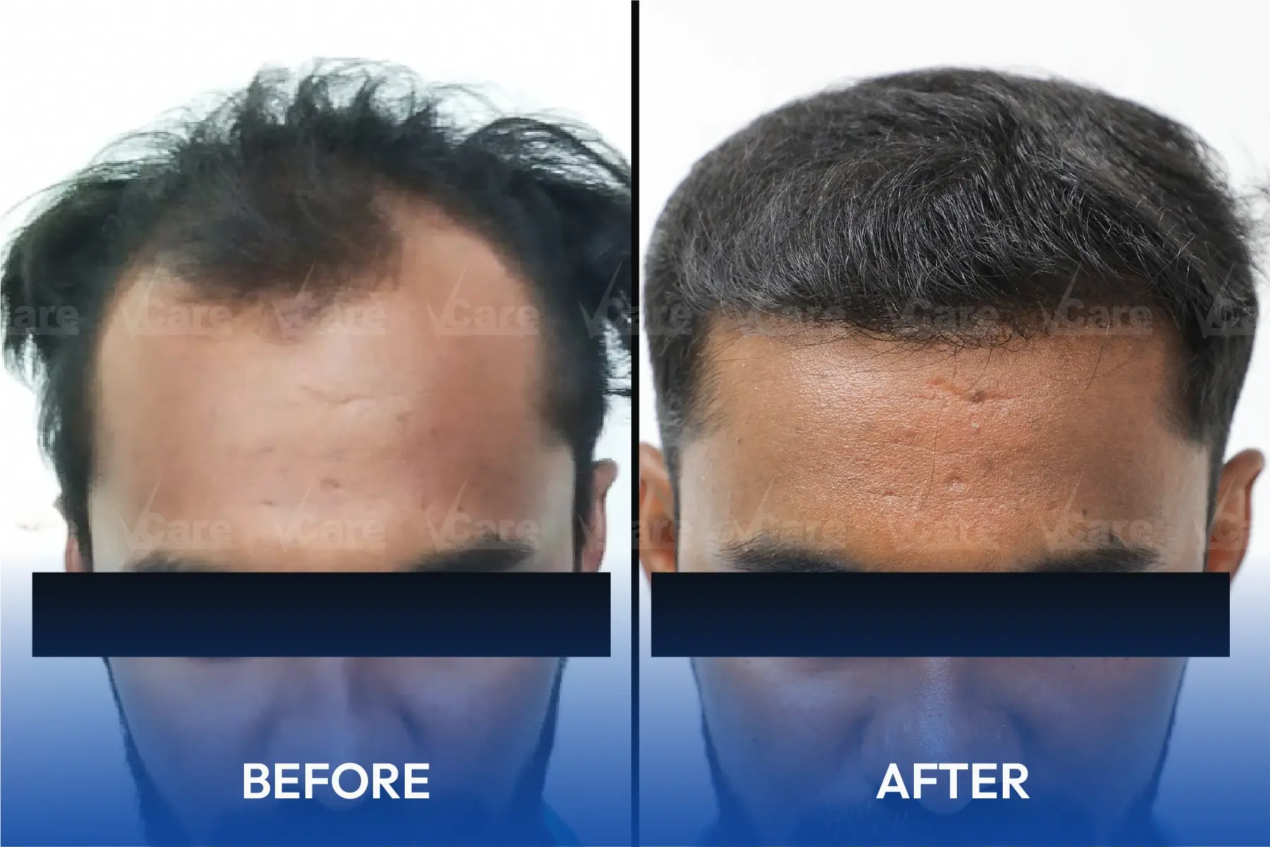 Laser Hair Removal Treatment