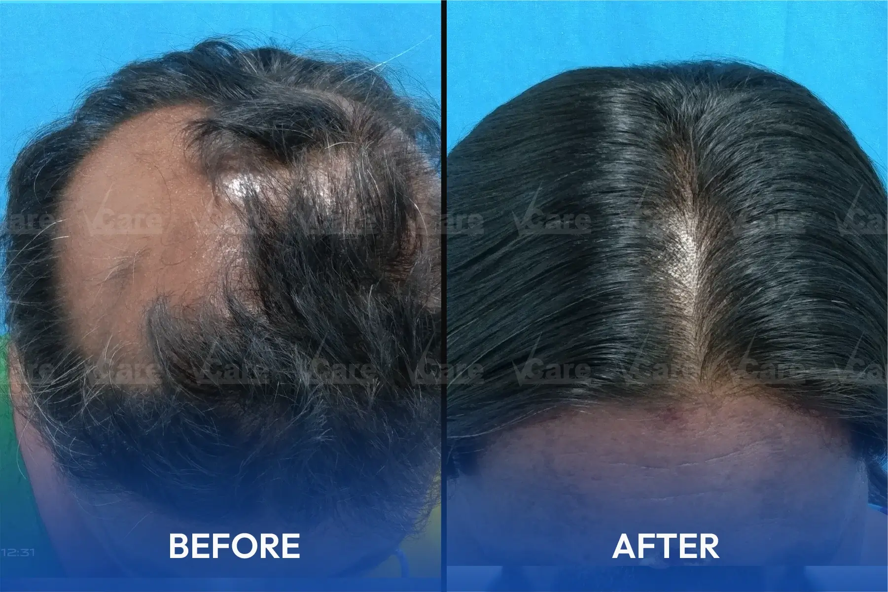Laser Hair Removal Treatment